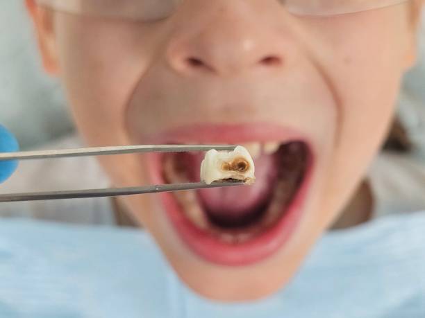 Best Emergency Dentist for Knocked-Out Tooth in Columbus, GA